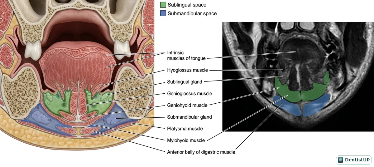 Coronal section through the floor of the mouth showing the sublingual and submandibular spaces separated by mylohyoid, with a matching MRI panel